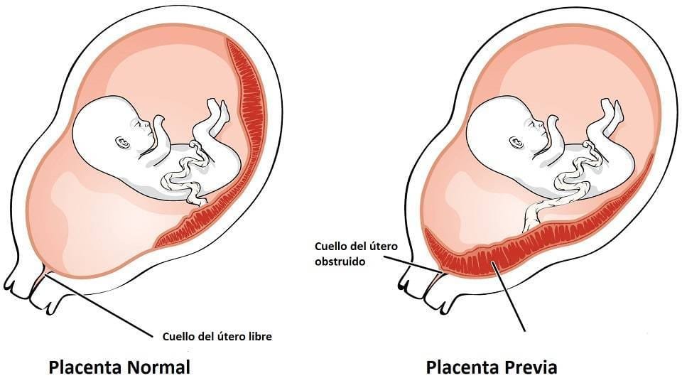 placenta previa