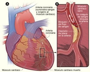 Paro cardíaco súbito