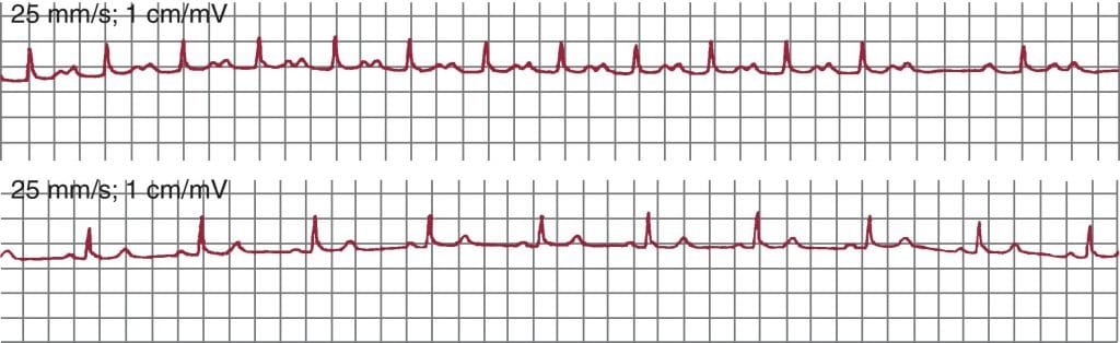 taquicardia auricular 1