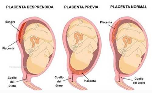 Desprendimiento de la placenta