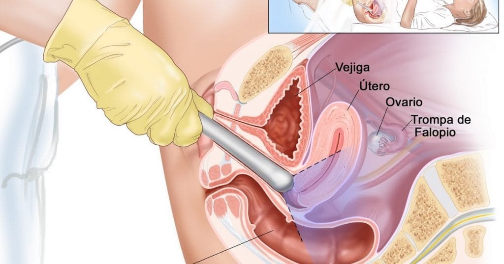 ¿Cómo se detecta el cáncer de endometrio?