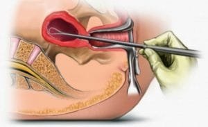 ¿Cómo se detecta el cáncer de endometrio?