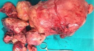 Sarcoma uterino