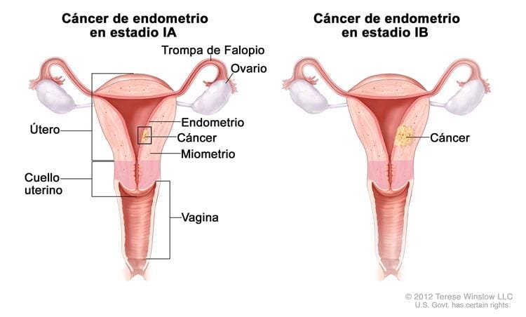 Cáncer de endometrio