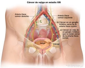 Cáncer de vejiga