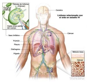 Cánceres relacionados con el sida