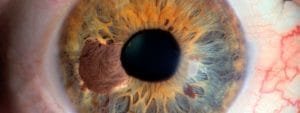 Melanoma ocular uveal