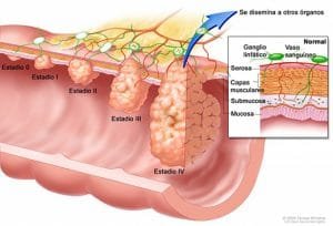 Síntomas de cáncer metastásico