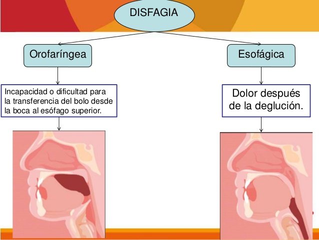 disfagia 4 638