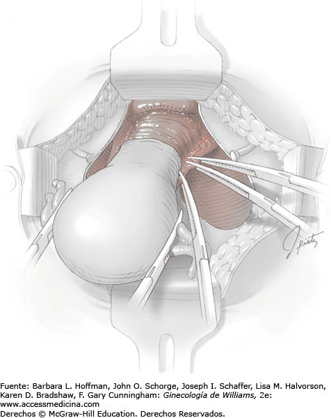 Sarcoma uterino