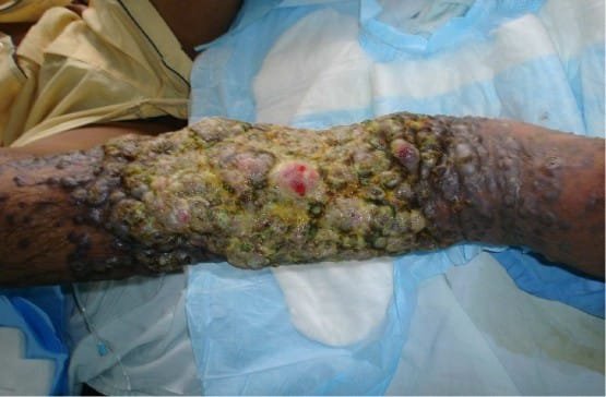 Sarcoma de Kaposi