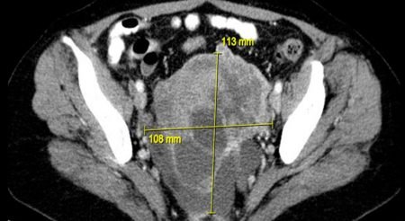 Sarcoma uterino recidivante - Tratamiento