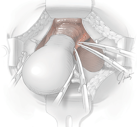 Sarcoma uterino recidivante - Tratamiento