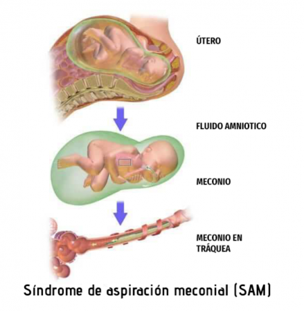 Síndrome de aspiración meconial