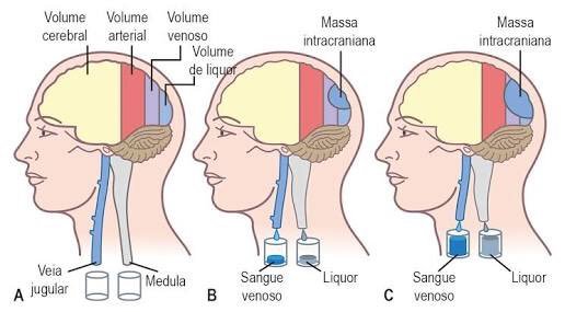 Presión intracraneal PIC y acciones de enfermería