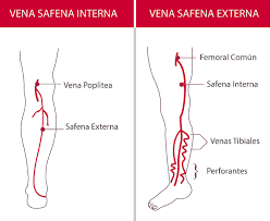 Venoclisis difícil