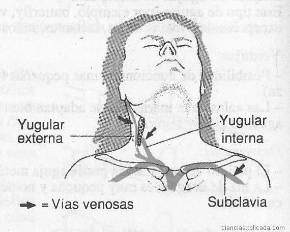 Venoclisis difícil