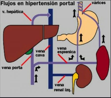 Varices esofágicas y gástricas 