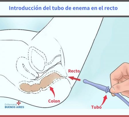 ¿Cuánto jabón coloco para preparar una enema?